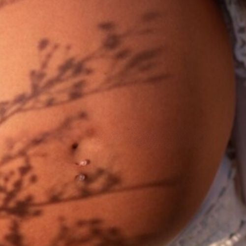 Endometriosis and fertility